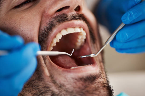 Best Emergency Tooth Extraction in Moraine, OH